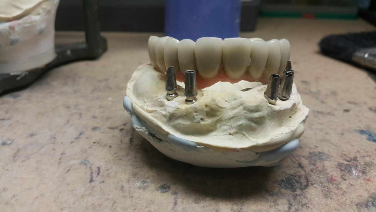 Selalu Di Balik Layar, Ini Loh Profesi Yang Membuat Gigi Palsu Pasien Dokter Gigi